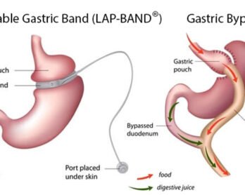 lap band surgery in Melbourne